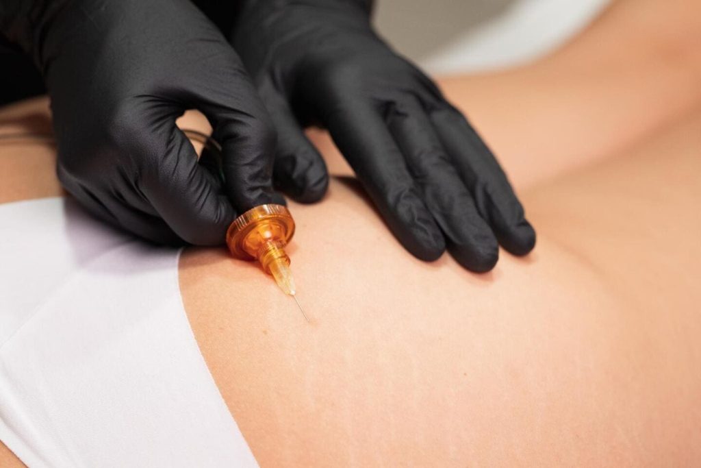 Carboxiterapia corporal 05