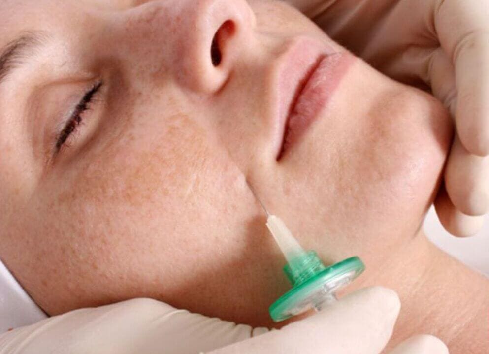 Carboxiterapia facial 04