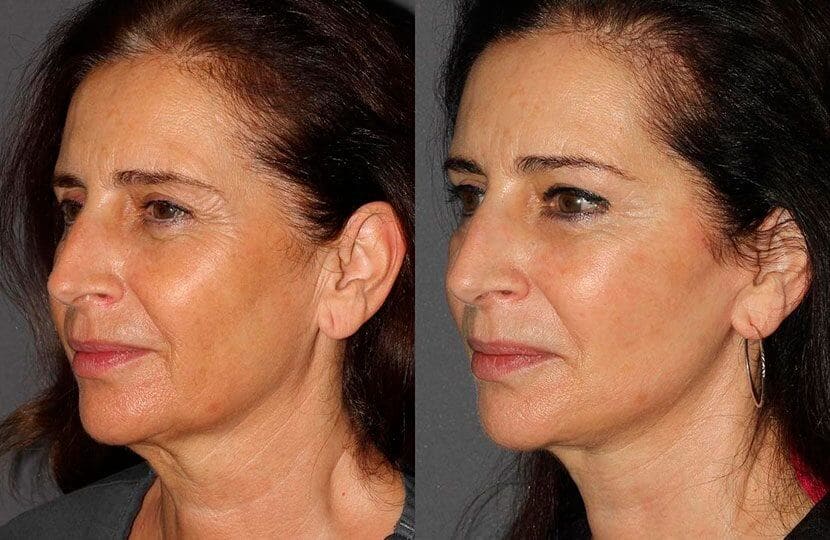 Liftin facial 02