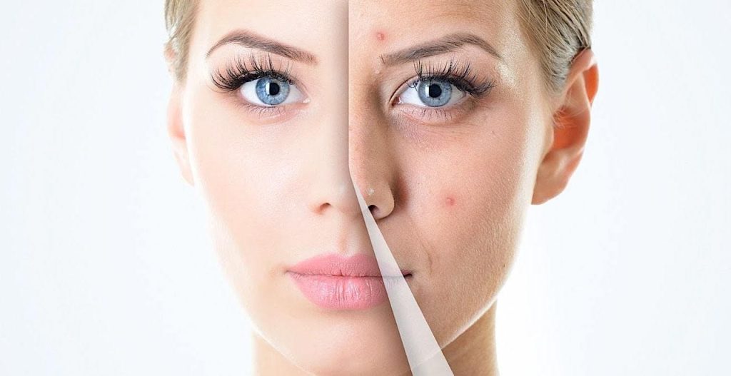Peeling quimico facial 02